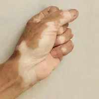 پاکــسازی مشــکـلات پوسـتی