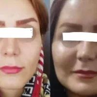 تپلی طبیعی
