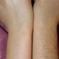 لیزر موی زاید،هایفو فشیال،فیلر مزو  در مطب آلالیزر|خدمات آرایشگری و زیبایی|کرج, حسین‌آباد|دیوار
