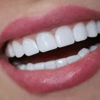 آفر ویژه دندانپزشکی آخر فصل ایمپلنت پر کردن
