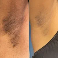 خدمات لیزر و رفع تیرگی و لاغری باتخفیف ویژه|خدمات آرایشگری و زیبایی|بجنورد, |دیوار