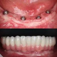 دندانپزشکی با اقساط بلند و وام دوساله درتبریز