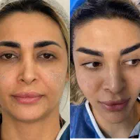 جراحی لیفت شقیقه دایرکت ابرو و تحتانی بخیه لیزری