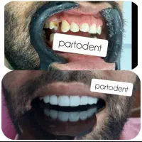 کامپوزیت در منزل. ایذه، باغملک، هفتکل|خدمات آرایشگری و زیبایی|ایذه, |دیوار