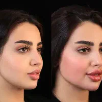 جشنواره تخفیف ویژه ژل بوتاکس مزو (حتی روزای تعطیل)