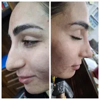 مطب پزشک ژل لب گونه چونه زاویه فک بوتاکس فیلر بینی|خدمات آرایشگری و زیبایی|قم, صفائیه|دیوار