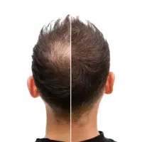 مزوتراپی مزونیدلینگ و پی آر پی PRP