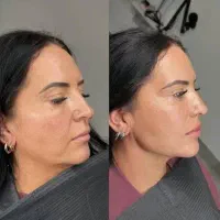 تخفیف فیلر گونه و لب