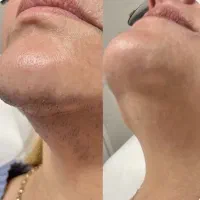 لیزر موهای زائد/روشن کننده بدن