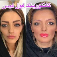فیلر.ژل.بوتاکس.زاویه سازی.پی ارپی فول فیس|خدمات آرایشگری و زیبایی|مشهد, سناباد|دیوار