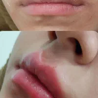 لیزر وزیبایی طلا