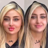 تزریق ژل بوتاکس لیفت صورت وشقیقه آنزیم مزو