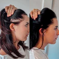 رویش مجدد مو تضمینی و قسطی|آرایشی، بهداشتی، درمانی|رشت, بلوار گیلان|دیوار