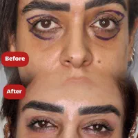 جراحی پلک / لیفت ابرو / لیفت صورت