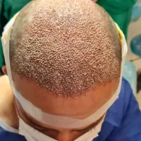 اموزش کاشت مو ریش ابرو