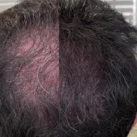 میکرو اسکالپ/ اسکالپ  رفع کم حجمی مو در کلینیک