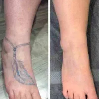 لیزر موهای زائد میکروسویچ و اپلومد کندلا وایتنینگ|خدمات آرایشگری و زیبایی|اصفهان, طامه|دیوار