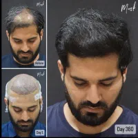 کاشت مو فقط در یک روز با ضمانت تراکم