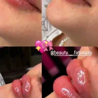 تزریق ژل و بوتاکس