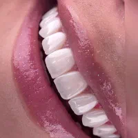 کامپوزیت دندان اقساطی