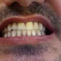 دندان مصنوعی متحرک|آرایشی، بهداشتی، درمانی|تهران, تهرانسر شرقی|دیوار