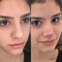 آنزیم ترکیبی بینی گوشتی،لیفت بینی،ژل لب،مزوتراپی|خدمات آرایشگری و زیبایی|تهران, سعادت‌آباد|دیوار