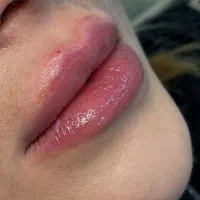 فیلر وبوتاکس