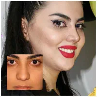 اخرین مهلت جشنواره عمل بینی با قیمت استثنایی