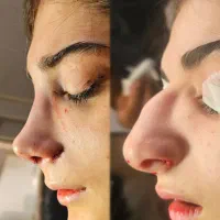 آف جراحی بینی ۲۰ت ولیپوساکشن وابدودراهواز