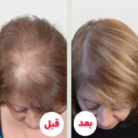 محلول ضد ریزش مو|آرایشی، بهداشتی، درمانی|بندر انزلی, آذربایجان|دیوار