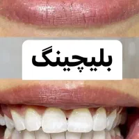 مدل خوش فیس برای بلیچینگ و سفیدکردن دندان|خدمات آرایشگری و زیبایی|تهران, دریاچه شهدای خلیج فارس|دیوار