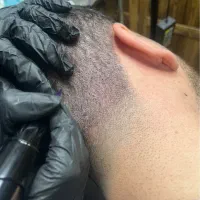 میکرواسکالپ تخصصی و میکروپیگمنتیشن