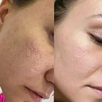 مزونیدلینگ