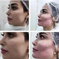 جشنواره پاییزه زیبایی ژل بوتاکس لیزر مزو|خدمات آرایشگری و زیبایی|رشت, نامجو|دیوار