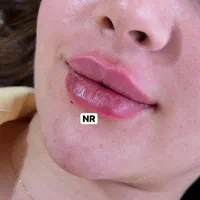 ژل و فیلر و بوتاکس