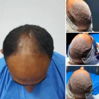 کاشت مو و ابرو