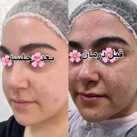 پاکسازی و فیشال /درمان جوش و لک و منافذباز