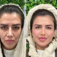 ژل بوتاکس فیلر فیشیال مزوتراپی توسط پزشک مجرب