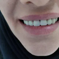 دندانسازی و دندان مصنوعی|خدمات آرایشگری و زیبایی|تبریز, |دیوار