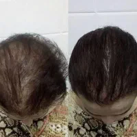 برای ریزش موهات و رویش مجدد موهات بیا اینجا
