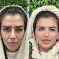 تزریق چربی،ژل،بوتاکس ونخ و مادلینگ تخصصی توسط پزشک|خدمات آرایشگری و زیبایی|کرمانشاه, |دیوار