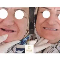 دندان مصنوعی / ژله ای / اوردنچر /چک صیادی / بیمه|خدمات آرایشگری و زیبایی|کرج, عظیمیه|دیوار
