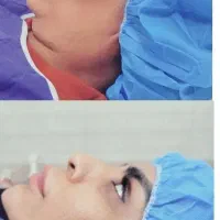 اعلام جشنواره ویژه ساکشن غبغب فقط با 8تومن