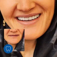 دندانسازی،دست دندان،دندان مصنوعی،پارسیل،پروتزمتحرک|خدمات آرایشگری و زیبایی|کرج, کوی مدرس|دیوار