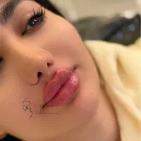 مدل ژل لب فیلر کات گونه سیب گونه چانه
