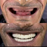 دندانسازی متحرک