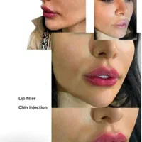 جشنواره تزریق ژل و بوتاکس و آموزش|خدمات آرایشگری و زیبایی|اصفهان, بهار آزادی|دیوار