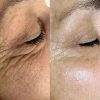 زیر چشماتو فیلر نزن