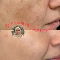 جوانسازی بیومیتیک بدون کار های تهاجمی|آرایشی، بهداشتی، درمانی|تهران, نگین غرب|دیوار