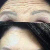 مدل ژل و بوتاکس(تزریق وآموزش مزو پی آرپی نخ میکر|خدمات آرایشگری و زیبایی|شیراز, ملاصدرا|دیوار